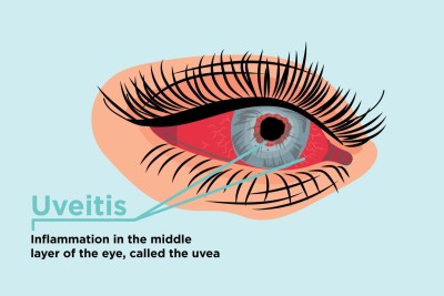 Uveitis